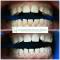 Igiene dentale professionale con ultrasuoni e sbiancamento ULTRA BLANCONE.